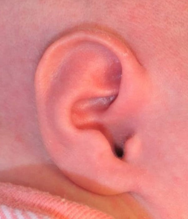 Ear Molding Gallery - Patient 642927 - Image 2