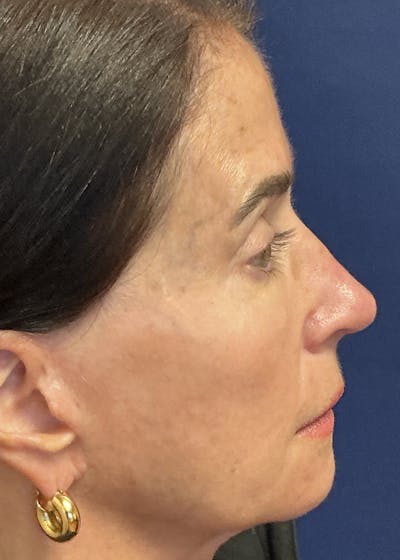 Rhinoplasty Gallery - Patient 228139 - Image 2