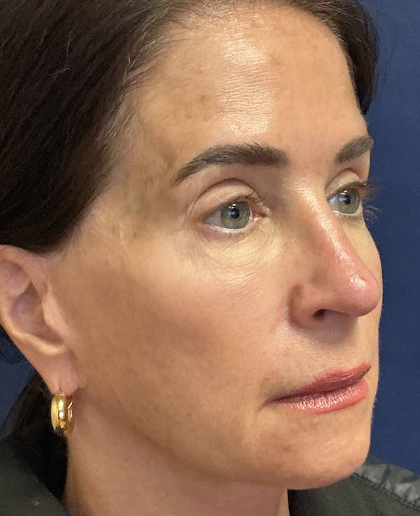 Rhinoplasty Gallery - Patient 228139 - Image 4