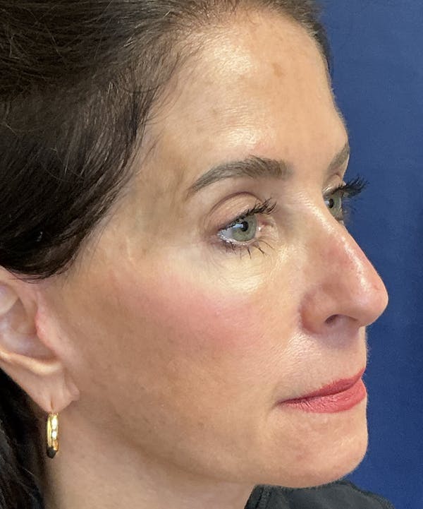 Rhinoplasty Gallery - Patient 228139 - Image 3