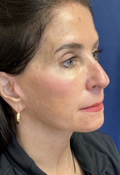 Facelift Gallery - Patient 569695 - Image 4