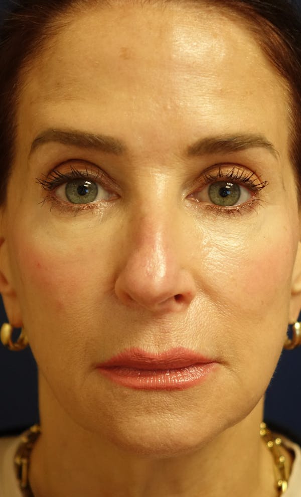 Facelift Gallery - Patient 569695 - Image 5