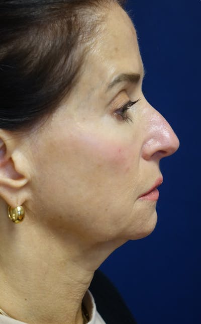 Facelift Gallery - Patient 569695 - Image 1