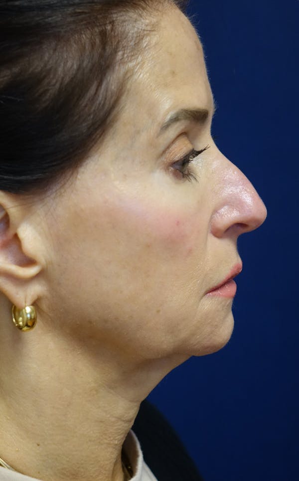 Facelift Gallery - Patient 569695 - Image 1
