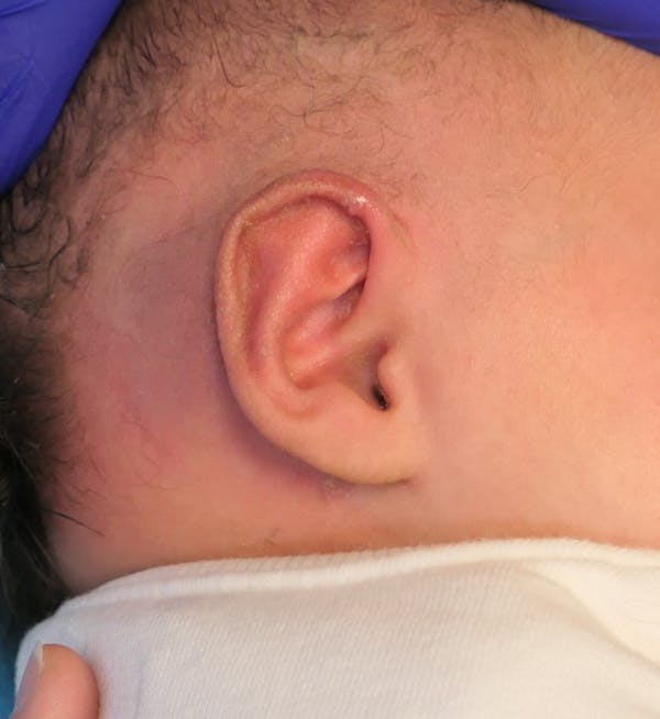 Pediatric Ear Molding Gallery - Patient 336527 - Image 2
