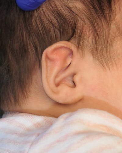 Pediatric Ear Molding Gallery - Patient 336527 - Image 1