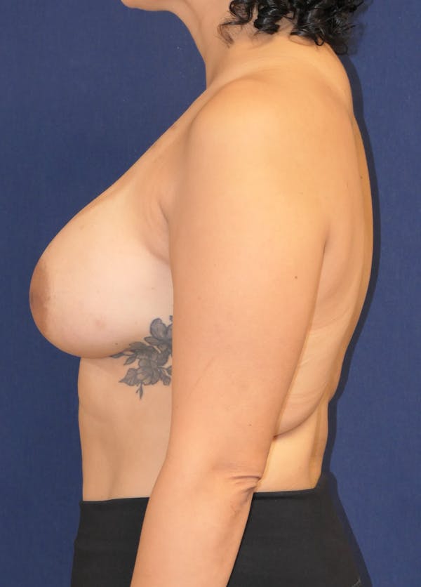 Breast Reconstruction with Implants Only Gallery - Patient 208758 - Image 10
