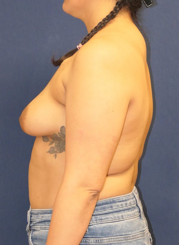Breast Reconstruction with Implants Only Gallery - Patient 208758 - Image 9
