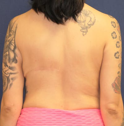 Breast Reconstruction with Autologous Tissue Gallery - Patient 132565 - Image 12