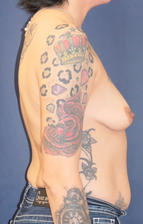 Breast Reconstruction with Autologous Tissue Gallery - Patient 132565 - Image 5