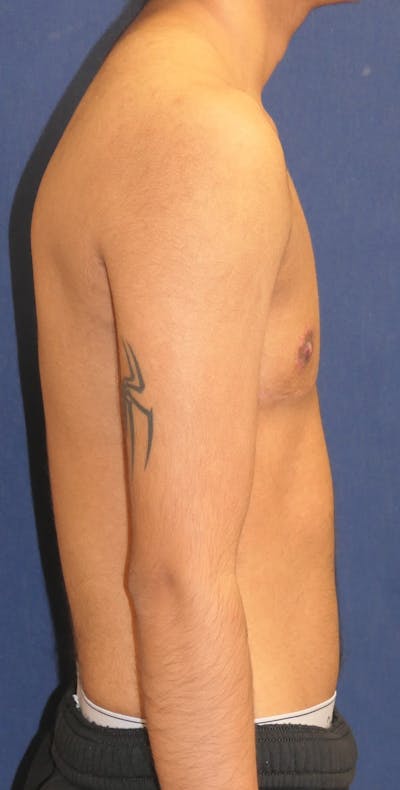 Masculinizing Surgery Gallery - Patient 998338 - Image 4