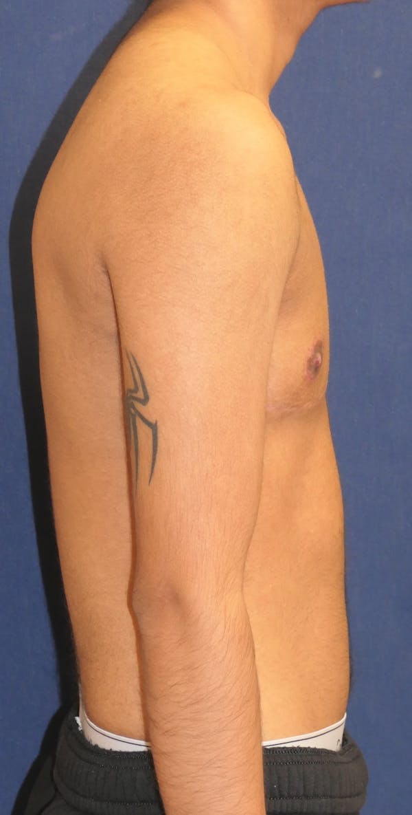 Masculinizing Surgery Gallery - Patient 998338 - Image 4