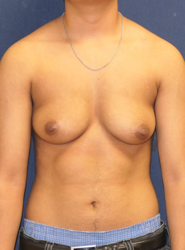 Masculinizing Surgery Gallery - Patient 998338 - Image 1