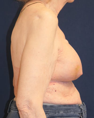 Breast Reconstruction with Implants Only Gallery - Patient 238092 - Image 6