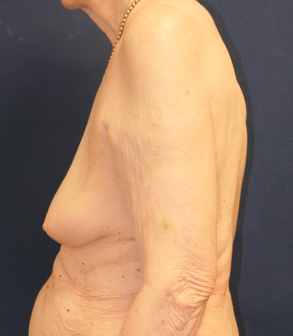 Breast Reconstruction with Implants Only Gallery - Patient 238092 - Image 9
