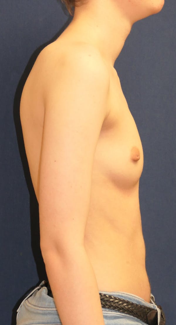 Masculinizing Surgery Gallery - Patient 203775 - Image 3