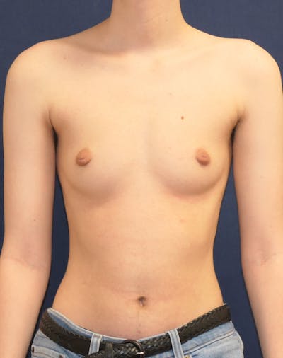 Masculinizing Surgery Gallery - Patient 203775 - Image 1
