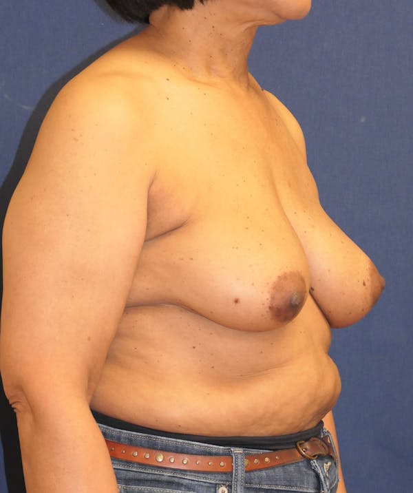 Breast Reconstruction with Implants Only Gallery - Patient 352858 - Image 4