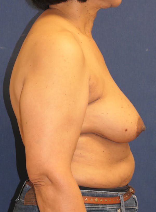 Breast Reconstruction with Implants Only Gallery - Patient 352858 - Image 6