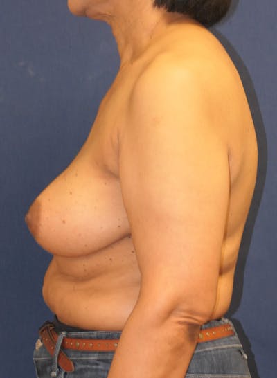 Breast Reconstruction with Implants Only Gallery - Patient 352858 - Image 10