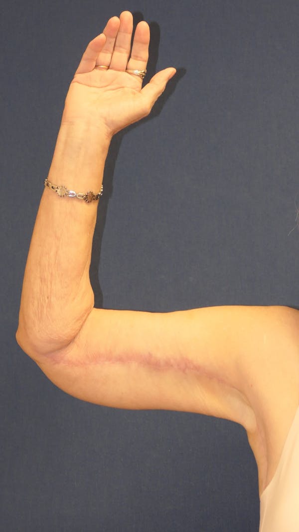 Arm Lift (Brachioplasty) Gallery - Patient 217195 - Image 8