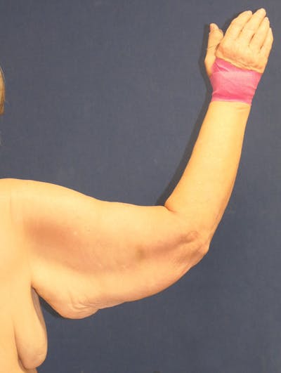 Arm Lift (Brachioplasty) Gallery - Patient 217195 - Image 1