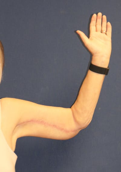 Arm Lift (Brachioplasty) Gallery - Patient 217195 - Image 4