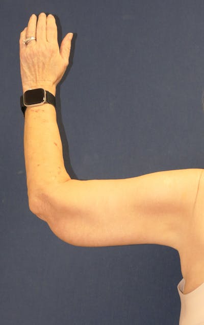 Arm Lift (Brachioplasty) Gallery - Patient 217195 - Image 6