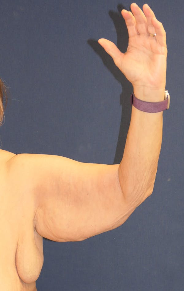 Arm Lift (Brachioplasty) Gallery - Patient 217195 - Image 3