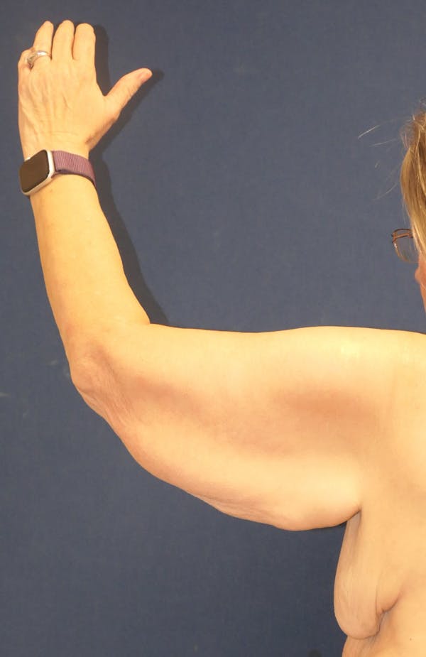 Arm Lift (Brachioplasty) Gallery - Patient 217195 - Image 5