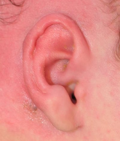 Ear Molding Gallery - Patient 403216 - Image 4