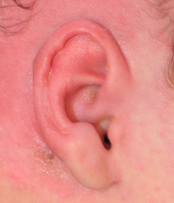 Ear Molding Gallery - Patient 403216 - Image 4