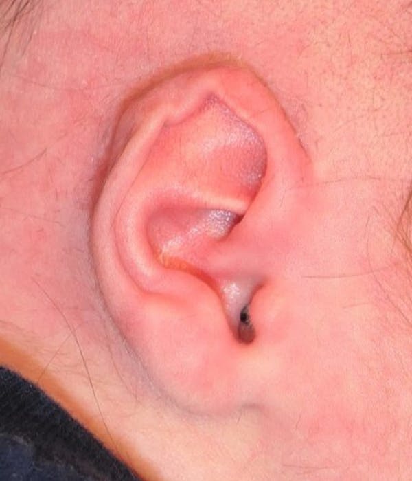 Ear Molding Gallery - Patient 403216 - Image 3