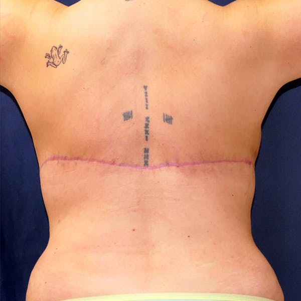 Back Lift Gallery - Patient 205011 - Image 2