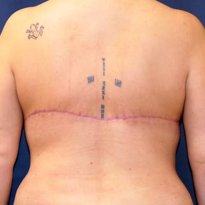 Back Lift Gallery - Patient 205011 - Image 4