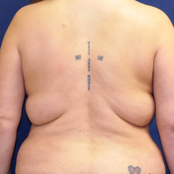 Back Lift Gallery - Patient 205011 - Image 3