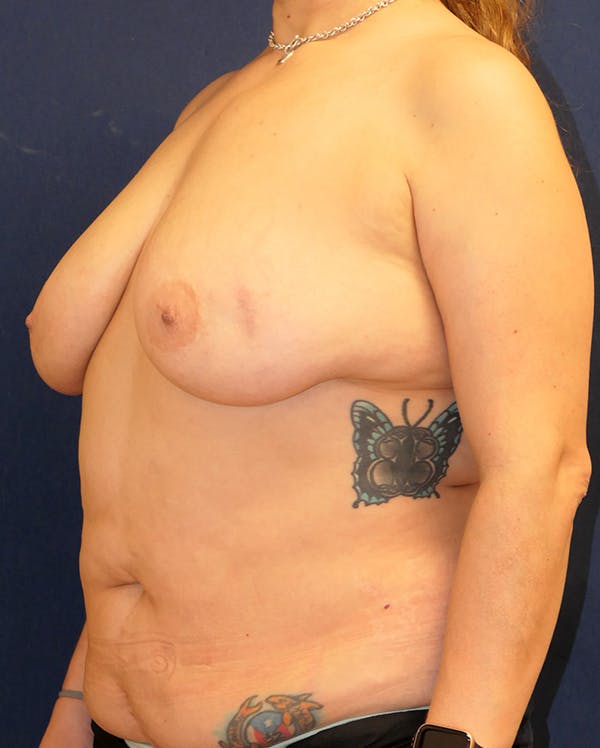 Breast Lift Gallery - Patient 281489 - Image 7