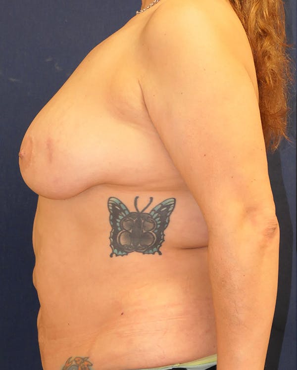 Breast Lift Gallery - Patient 281489 - Image 9