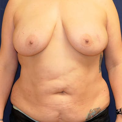 Tummy Tuck (Abdominoplasty) Gallery - Patient 407659 - Image 1