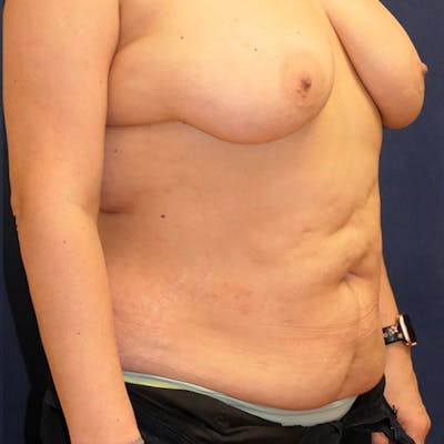 Tummy Tuck (Abdominoplasty) Gallery - Patient 407659 - Image 4