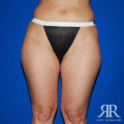 Mommy Makeover Liposuction Beverly Hills