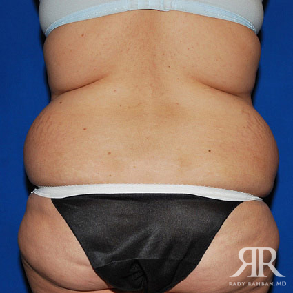 Liposuction After Pregnancy