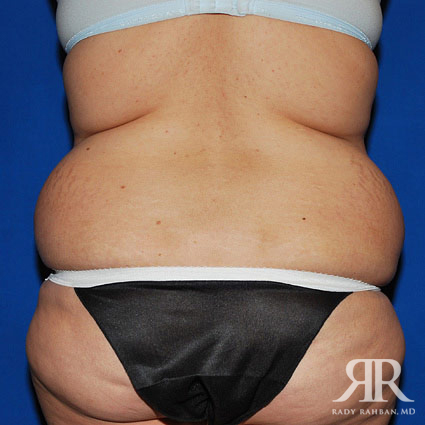 Liposuction After Pregnancy  Beauty After Baby Beverly Hills