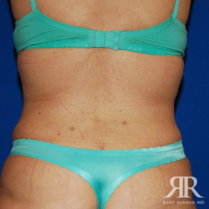 Mommy Makeover Liposuction