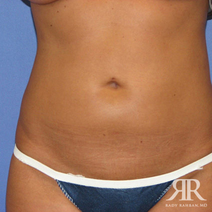 Liposuction Before & After Photo 03