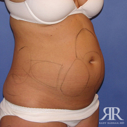 Liposuction