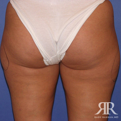 Liposuction