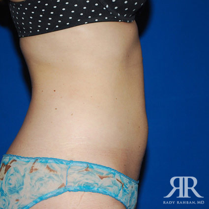 Liposuction