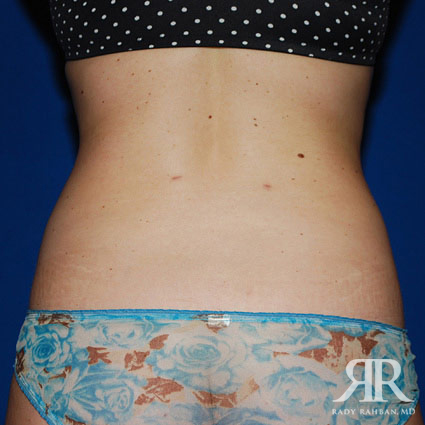 Liposuction