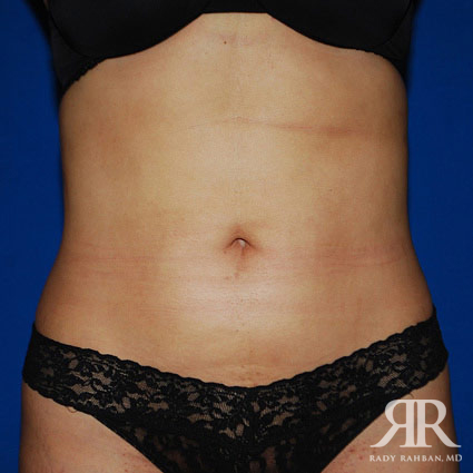 Liposuction